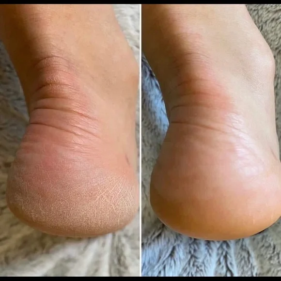 - (2) TWO Epoch NuSkin Sole Solution foot treatment